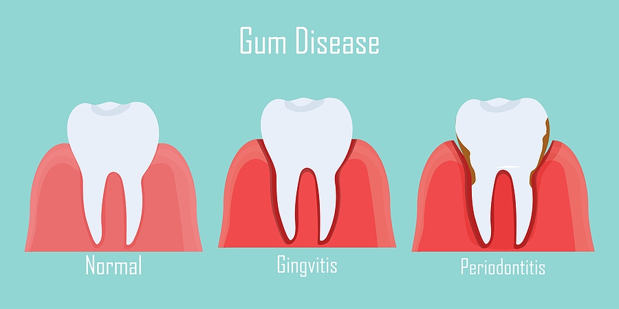 Gum Disease - Dr. Rick Mars